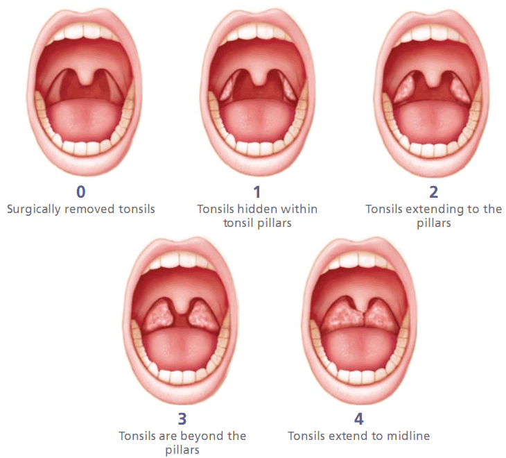 tonsillectomy-mpenta