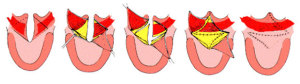 Submucous-Cleft-Palate-Repair