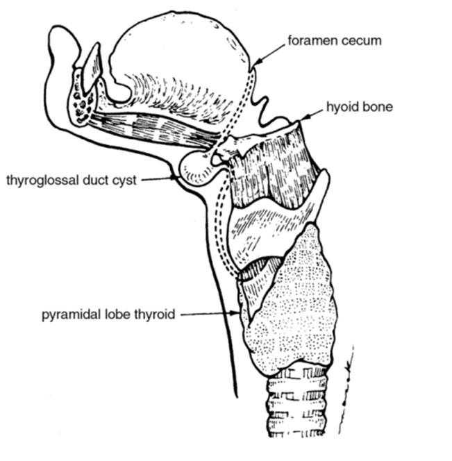 Thyroglossal-Duct-Cyst