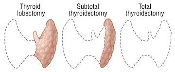 Thyroidectomy types