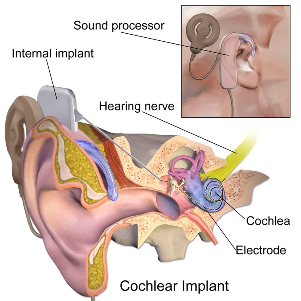 Cochlear Implant Surgery for Children MPENTA Pediatric ENT